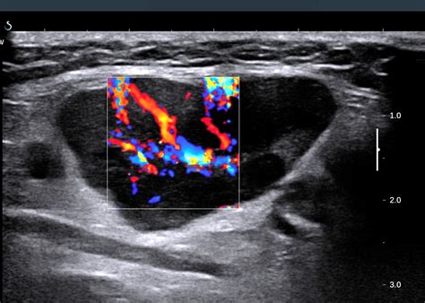 Vietnamese Medic Ultrasound Case 435 Cervical Lymph Nodes Dr Phan