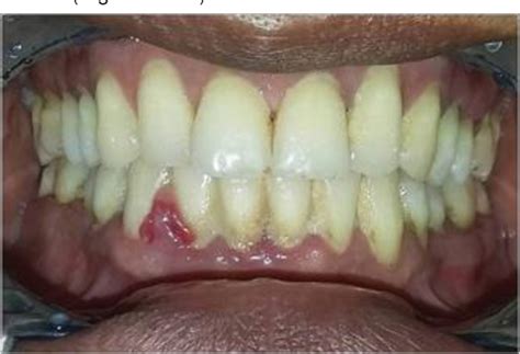 Management Of Chronic Gingivitis With Localized Periodontitis By