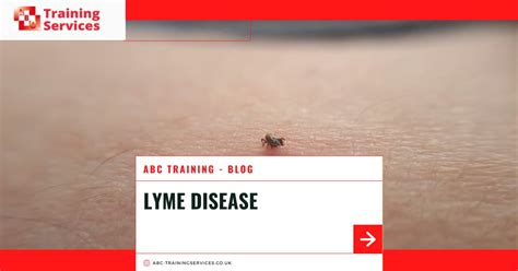 Lyme Disease Symptoms Cause And Treatment Abc Training