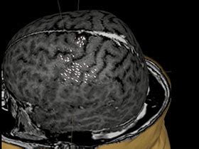 Nexstim said today that it won fda 510(k) clearance for a new, shorter treatment protocol for its navigated brain therapy transcranial magnetic stimulation system intended to treat major depressive. Nexstim - Radiotherapy