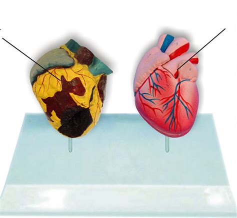 1 1 Lifesize Human Smoking Heart Vs Normal Heart Comparison Model Heart Anatomy Model Human