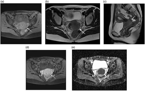 Contrast Enhanced Mri A Axial Fat Suppressed T1w Images B Axial