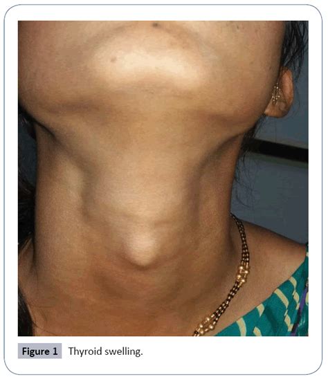 Swollen Neck Thyroid