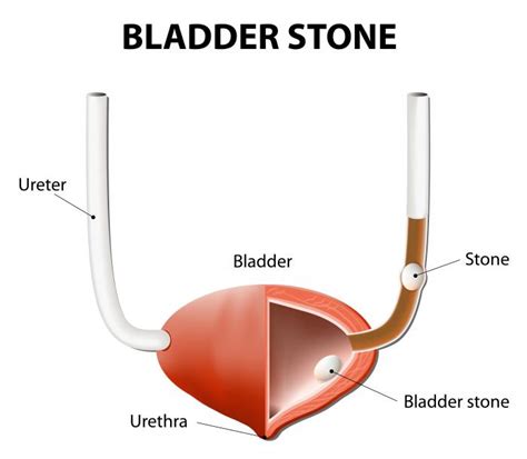 Bladder Stones Causes Symptoms And Treatments