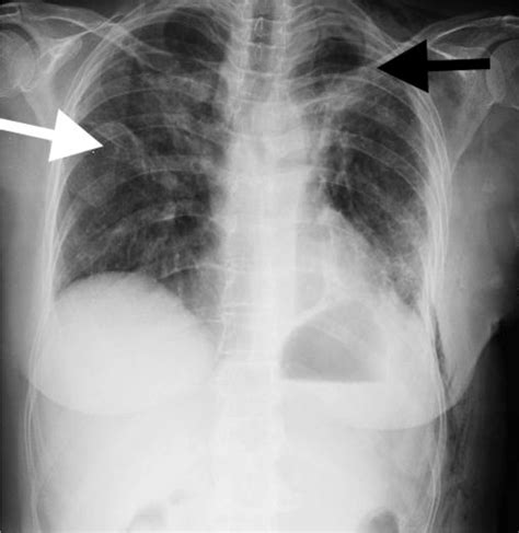 A Chest X Ray Showing A Cavitary Lesion On The Left Upper Zone Black