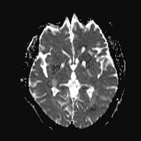 Acute Disseminated Encephalomyelitis Image