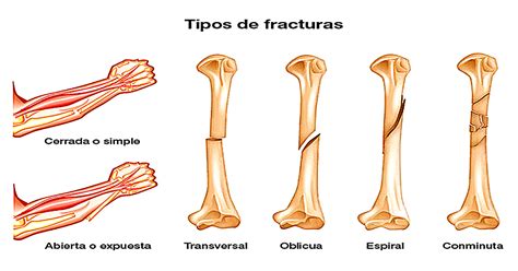 5 Síntomas Del Cáncer En Los Huesos Primario Que Debes Conocer