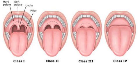 Swollen Uvula Causes Pictures Remedies And Treatment 2018 Updated