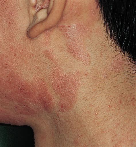 Allergic Contact Dermatitis Treatment Pictures Photos