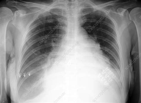 Enlarged Heart X Ray Stock Image F0356524 Science Photo Library