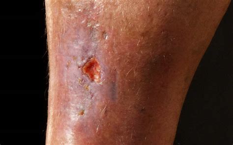 10 Top Tips On Leg Ulcers For Healthcare Professionals Legs Matter