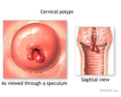 The New York Times Health Image Cervical Polyps