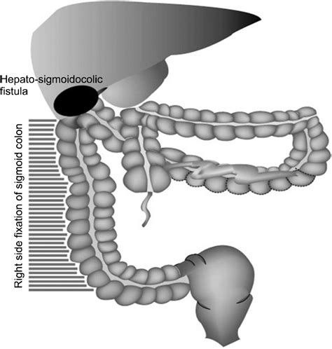 Schematic Drawing Of The Operation Finding Sigmoid Colon And Upper Download Scientific Diagram