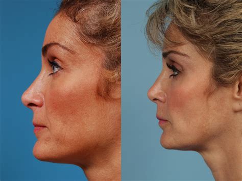 Revision Rhinoplasty Before And After Photos Patient 242 Chicago Il