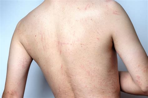 Guidelines Developed For Managing Severe Atopic Dermatitis Retail