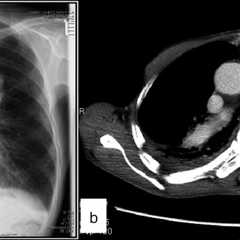 A Chest Radiograph Showed A Large Mass In The Left Upper Lung B