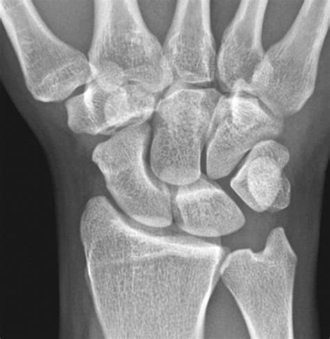 Carpal Bone Fracture