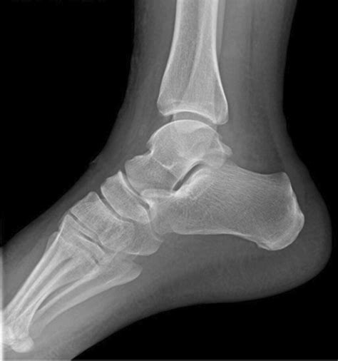Left Ankle Radiograph Demonstrating Soft Tissue Swelling But No Bony