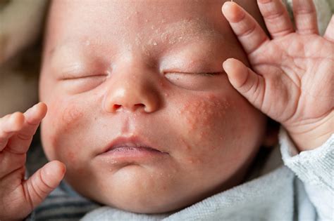 Closeup Of The Face Of A Newborn Baby With Pimples On The Cheeks Due To