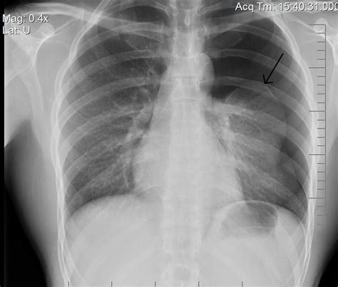 14 Pneumothorax And Pleural Effusion Simplemed Learning Medicine