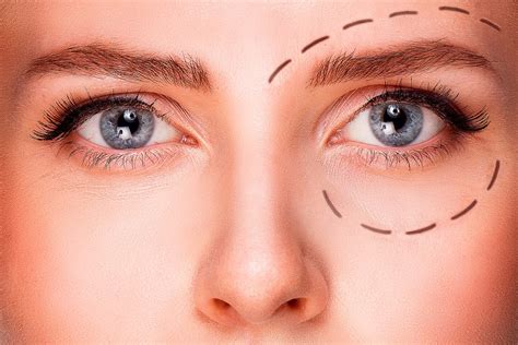 Droopy Eyelid Surgery
