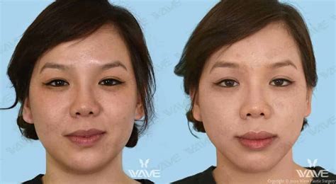 Before And After Photo Gallery Wave Plastic Surgery
