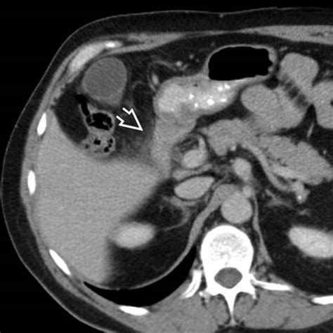 Duodenitis Radiology Key