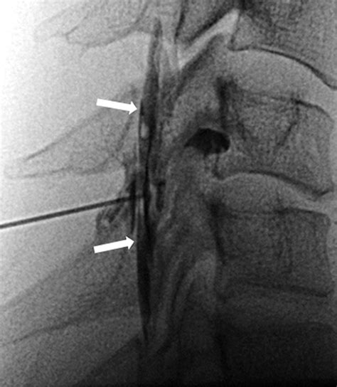 Fluoroscopically Guided Epidural Injections Of The Cervical And Lumbar