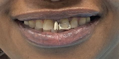 Happy Patients Desoto Dentures And Implants Southaven Ms