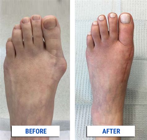 After Your Bunion Surgery Alpine Foot Specialists