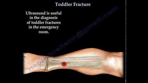 Toddler Fracture Tibial Fracture In A Child Everything You Need To