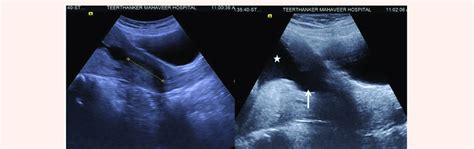 Transabdominal Ultrasound Of The Cervix A Cervical Length