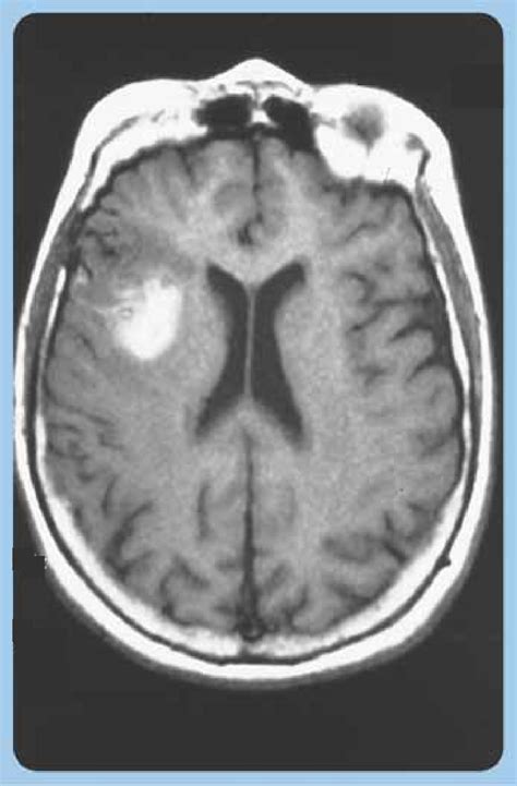 Brain Magnetic Resonance Imaging Of A Sylvian Cardioembolic Hemorrhagic