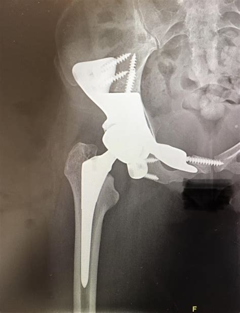 Hemipelvectomy And Full Right Hip Replacement Due To Stage 2