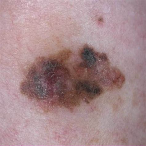 Skin Cancer Malignant Melanoma Dr Rima Clayton Dermatologist