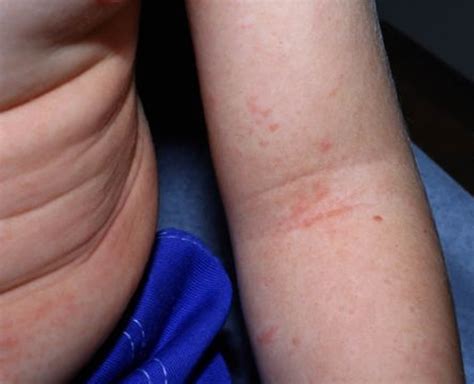 Scarlet Fever Causes Symptoms Long Term Effects Treatment