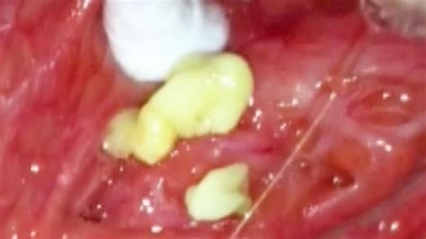 Popping My Tonsil Stones Youtube