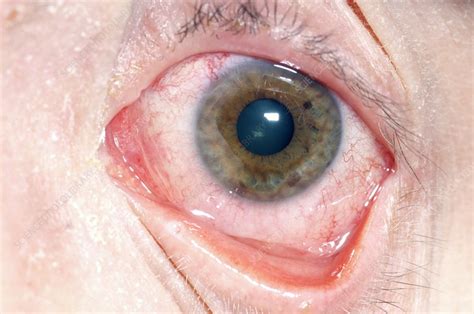 Herpes Simplex Infection Of The Eye Stock Image C0111800 Science