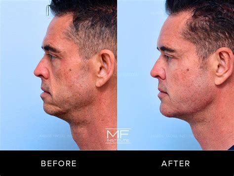 Jawline Contouring With Filler For Bay Area Men