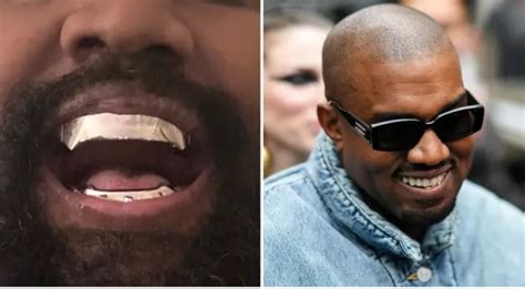 Kanye West Replaces Teeth With 850000 Titanium Dentures