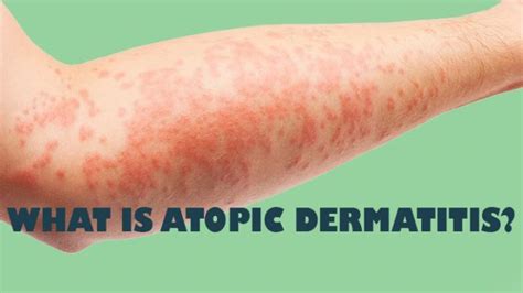 What Is Atopic Dermatitis Syn Atopic Eczema Eczema Ige Dermatitis