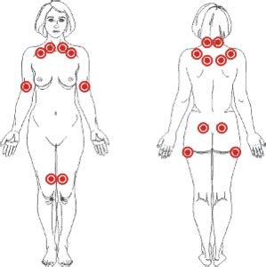 Aspects on the epidimiology and criteria of myofascial pain and fibromialgia //scandinavian journal of rheumatology. dr Bruno B Gobbato