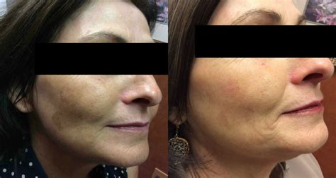 Chemical Peels Skin Rejuvenation In New Jersey