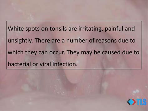 Ppt Causes Of White Spots On Tonsils You May Not Know Powerpoint