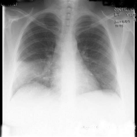 Chest X Ray Pa View At Initial Presentation Showing Early Right Lower