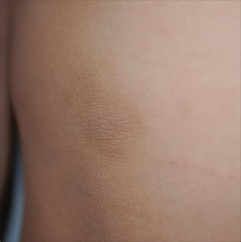 Multiple Brown Patches On The Trunk—quiz Case Allergy And Clinical