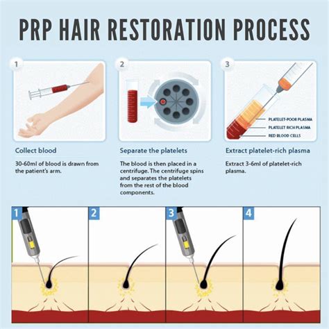 Prp Hair Restoration Orange Wellness