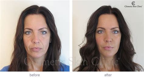 Juvederm Non Surgical Face Lift Face Fillers Facial Fillers