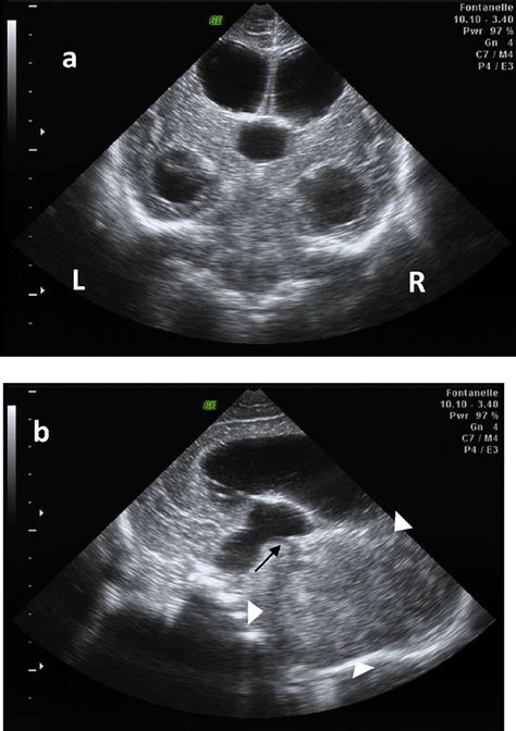 Dilated 3rd Ventricle Fetal Ultrasound