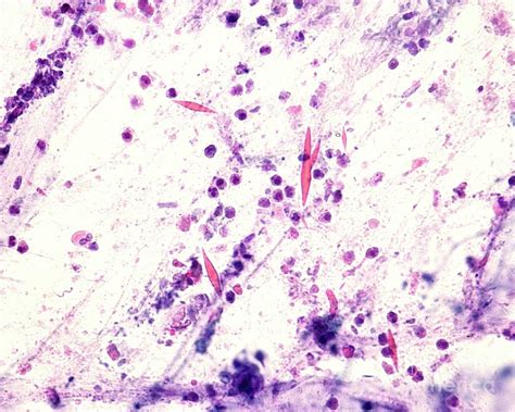 Cristais De Charcot Leyden